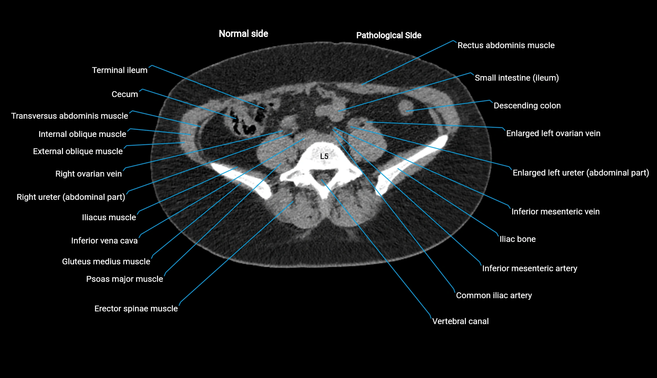 CT KUB axial cross sectional anatomy  radiology image -img-00201-00100.webp